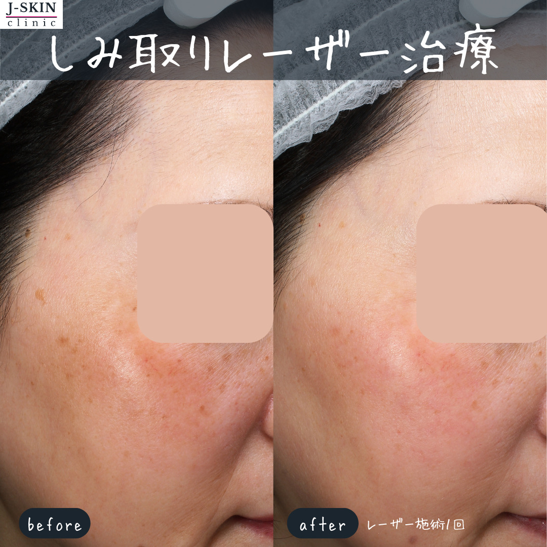 肝斑(かんぱん)とは治療可能なシミの一種です - JSKINクリニック東京